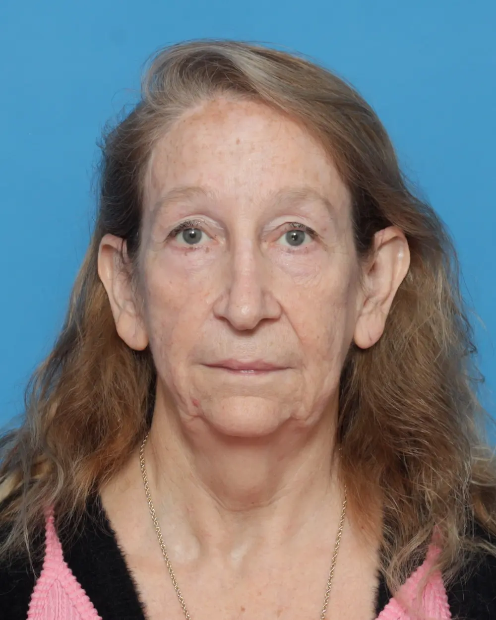 Eyelid Surgery Patient Photo - Case 13927 - before view-