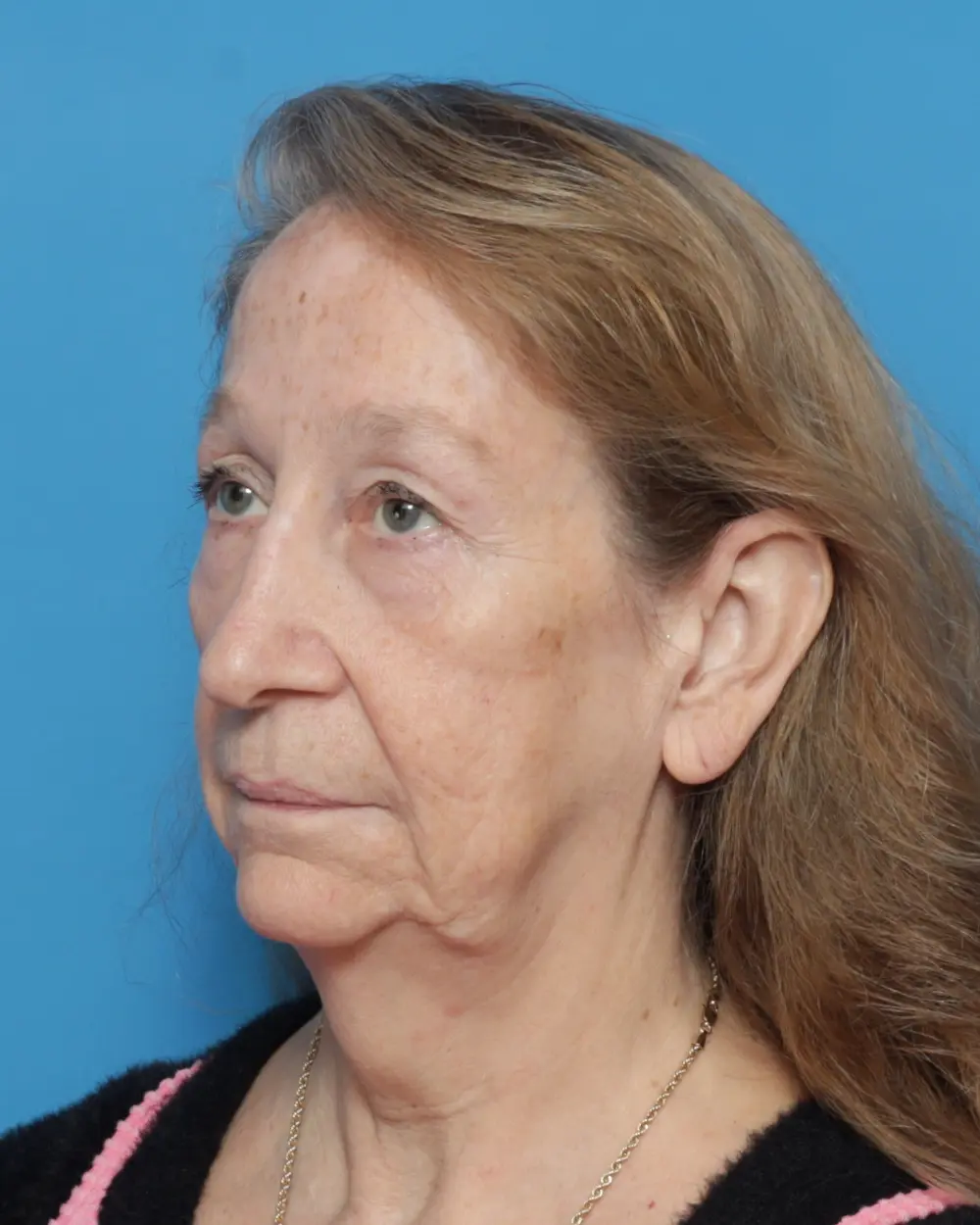 Eyelid Surgery Patient Photo - Case 13927 - before view-3