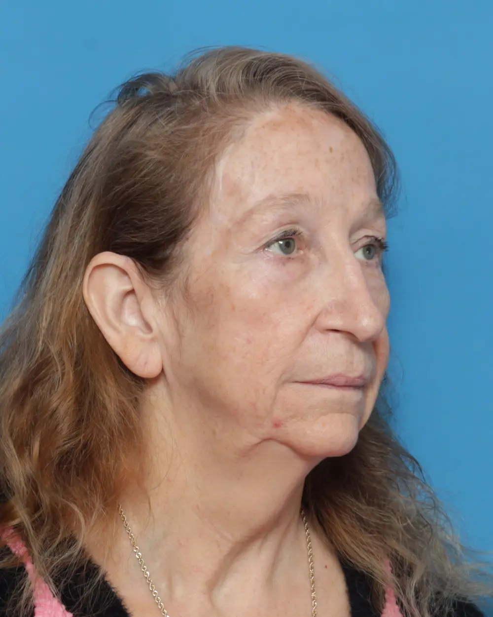 Eyelid Surgery Patient Photo - Case 13927 - before view-1