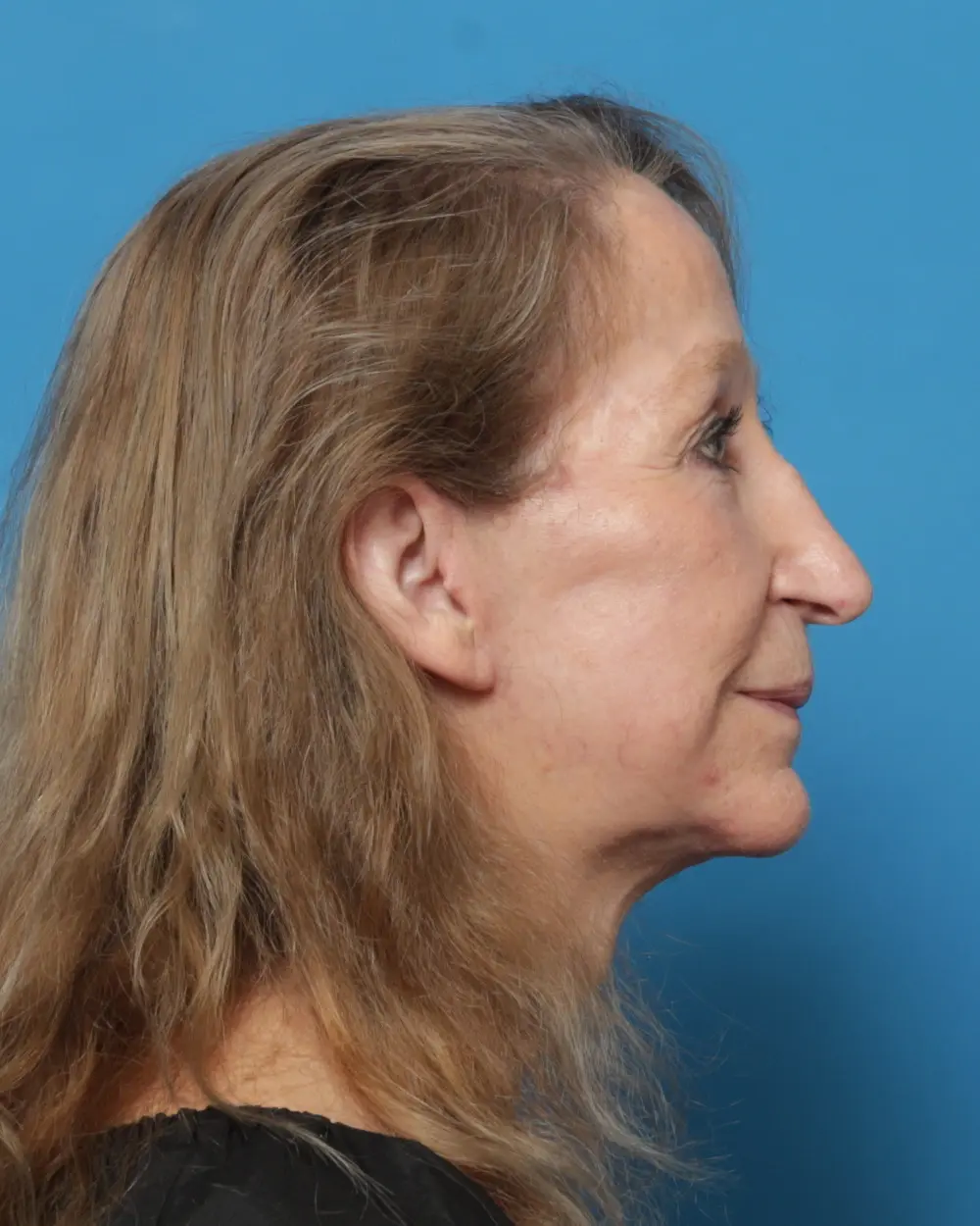Eyelid Surgery Patient Photo - Case 13927 - after view-2