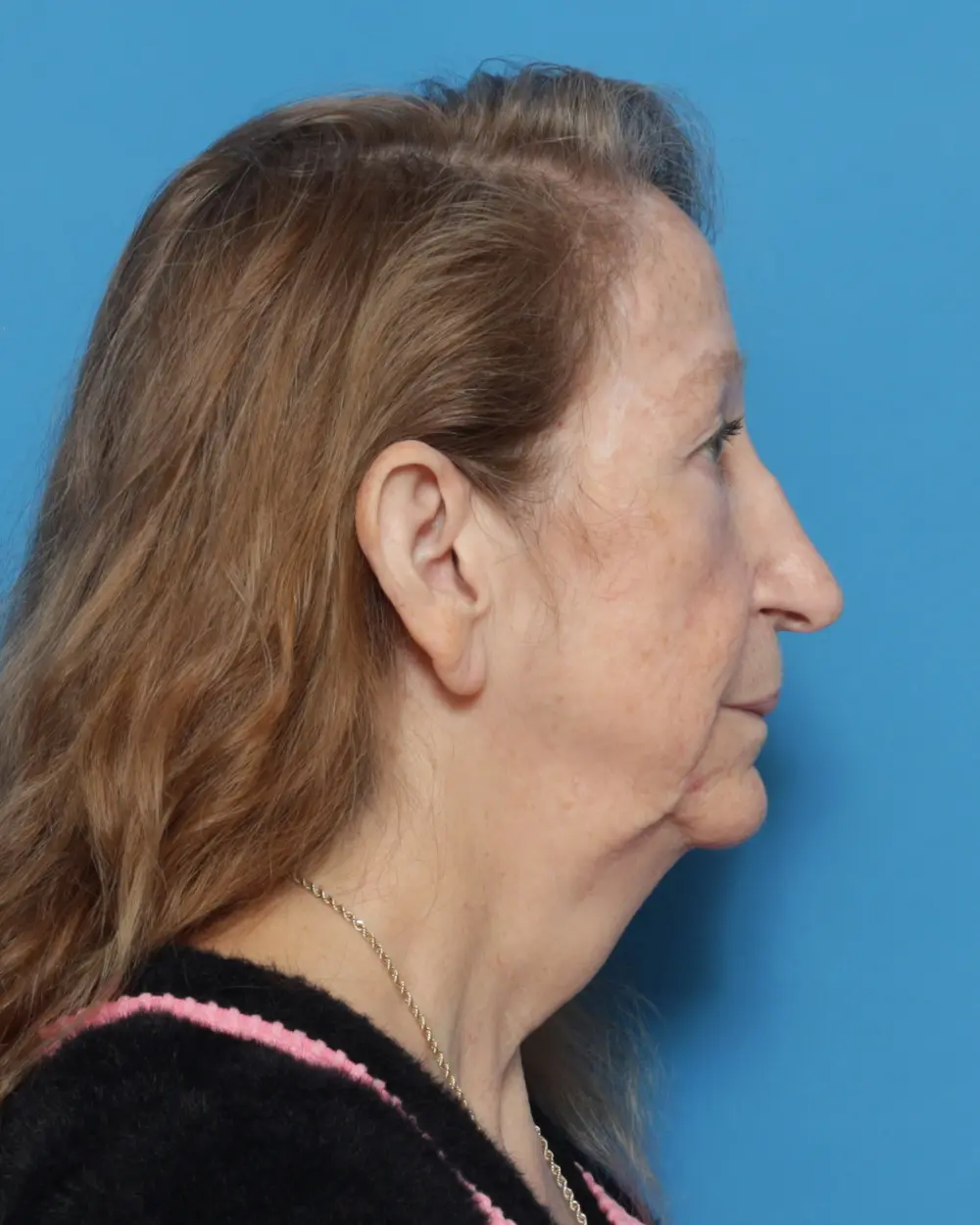 Eyelid Surgery Patient Photo - Case 13927 - before view-2