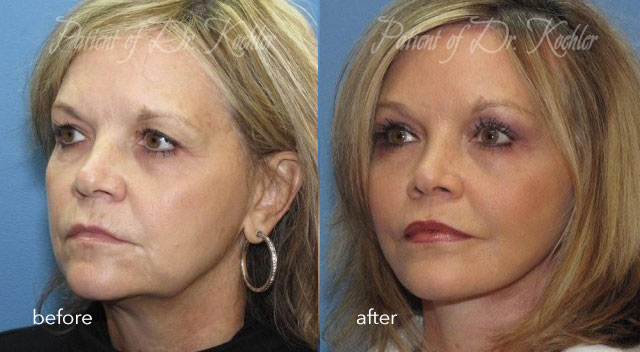 before and after face lift