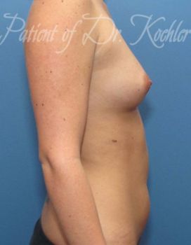 Breast Augmentation Patient Photo - Case 27 - before view-1