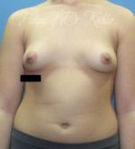 Breast Augmentation - Case 49 - Before