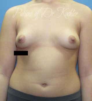 Breast Augmentation Patient Photo - Case 49 - before view-0