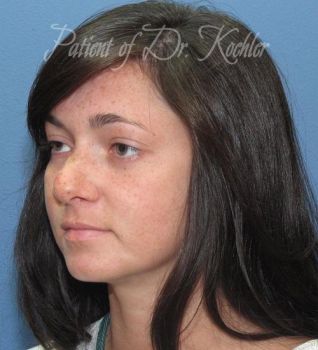 Rhinoplasty Patient Photo - Case 86 - before view-2