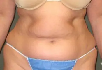 Tummy Tuck Patient Photo - Case 96 - before view-0