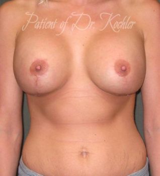 Breast Augmentation/Lift Patient Photo - Case 65 - after view-0