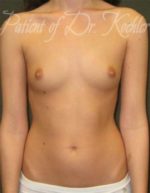 Breast Augmentation - Case 15 - Before