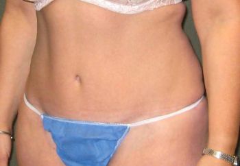 Tummy Tuck Patient Photo - Case 96 - after view-2