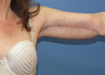Arm Lift Patient Photo - Case 102 - after view