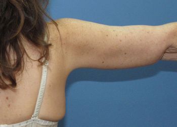 Arm Lift Patient Photo - Case 102 - after view-2