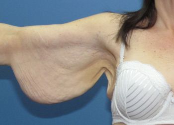 Arm Lift Patient Photo - Case 102 - before view-1