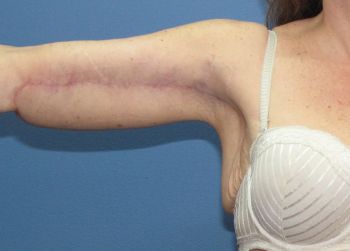 Arm Lift Patient Photo - Case 102 - after view-1