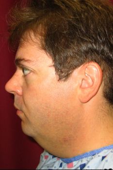 Chin Implant Patient Photo - Case 85 - before view-1