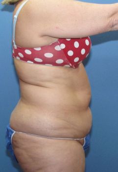 Liposuction Patient Photo - Case 109 - before view-2