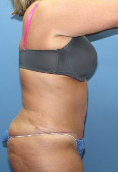 Tummy Tuck Patient Photo - Case 109 - after view-2