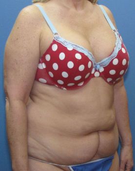 Liposuction Patient Photo - Case 109 - before view-1