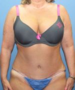 Liposuction - Case 109 - After