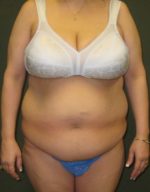 Liposuction - Case 110 - Before