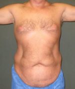 Liposuction - Case 111 - Before