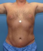 Tummy Tuck - Case 111 - After
