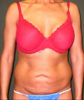 Liposuction Patient Photo - Case 112 - before view-0