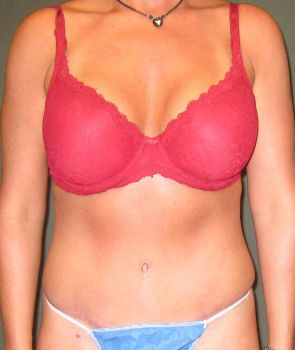 Liposuction Patient Photo - Case 112 - after view