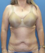 Liposuction - Case 114 - Before