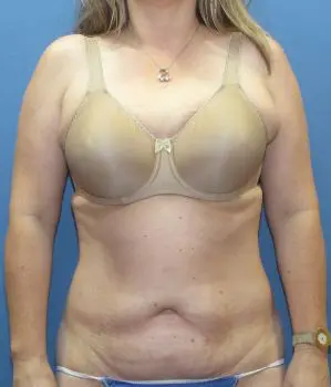 Liposuction Patient Photo - Case 114 - before view-