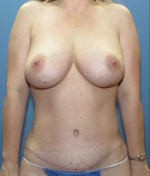 Tummy Tuck Patient Photo - Case 114 - after view-0
