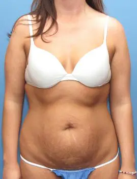 Liposuction Patient Photo - Case 115 - before view-