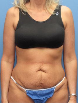 Tummy Tuck Patient Photo - Case 116 - before view-