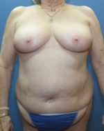 Liposuction - Case 121 - Before