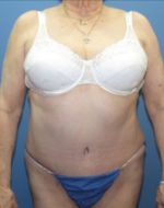 Tummy Tuck - Case 121 - After