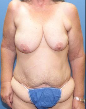 Liposuction Patient Photo - Case 123 - before view-