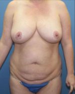 Liposuction - Case 124 - Before