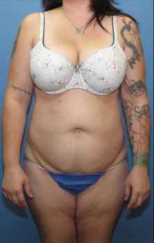 Liposuction Patient Photo - Case 125 - before view-