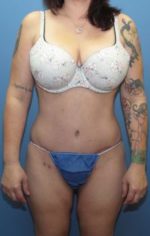 Tummy Tuck - Case 125 - After