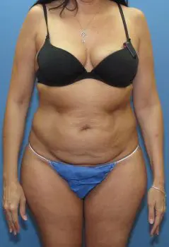 Liposuction Patient Photo - Case 126 - before view-