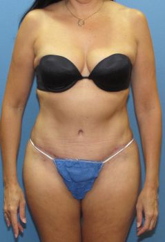 Tummy Tuck Patient Photo - Case 126 - after view-0