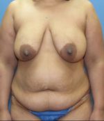 Liposuction - Case 127 - Before