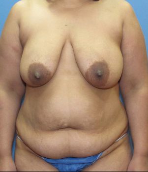 Tummy Tuck Patient Photo - Case 127 - before view-
