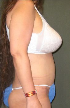 Tummy Tuck Patient Photo - Case 110 - after view-1