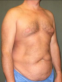 Liposuction Patient Photo - Case 111 - before view-2