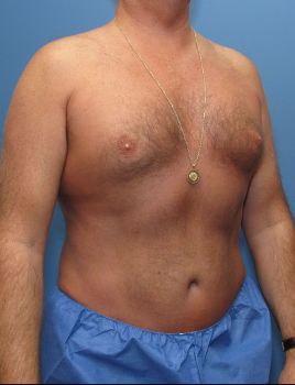 Liposuction Patient Photo - Case 111 - after view-2