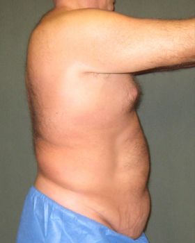 Liposuction Patient Photo - Case 111 - before view-1
