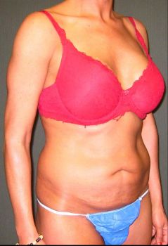 Tummy Tuck Patient Photo - Case 112 - before view-2