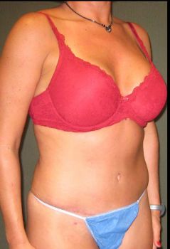 Tummy Tuck Patient Photo - Case 112 - after view-2