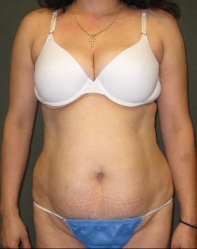 Liposuction Patient Photo - Case 128 - before view-0